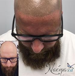 Scalp Micro Pigmentation Capillaire au Centre du Québec - Naéma.ca, Durham-Sud, QC opening hours